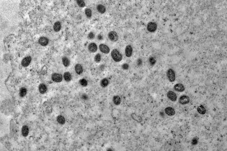 Pesquisa indica risco de monkeypox agravar infecção por HIV