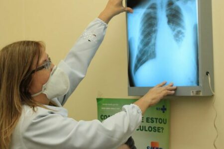 Conselho aprova novas diretrizes para tratamento da tuberculose no SUS